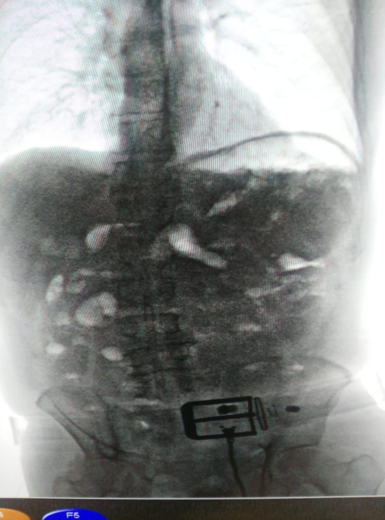 Capturado-un-pasajero-con-más-de-un-kilo-de-cocaína-en-el-abdomen